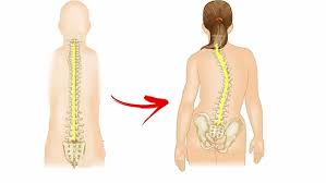/Treatment of congenital spinal cord and spinal cord anomalies